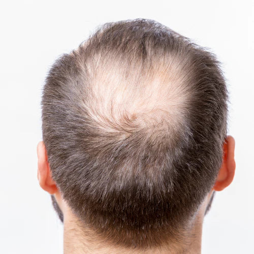 Hair loss remedy: The best products to tackle hair loss