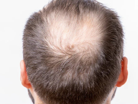 Hair loss remedy: The best products to tackle hair loss
