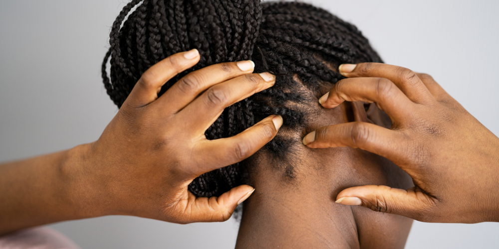 El cuero cabelludo irritado: Todo lo que necesitas saber sobre la inflamación del cuero cabelludo