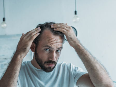 The Norwood scale: A guide to male pattern baldness