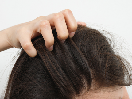 Soffrite di psoriasi sul cuoio capelluto? Scoprite le cause e le soluzioni