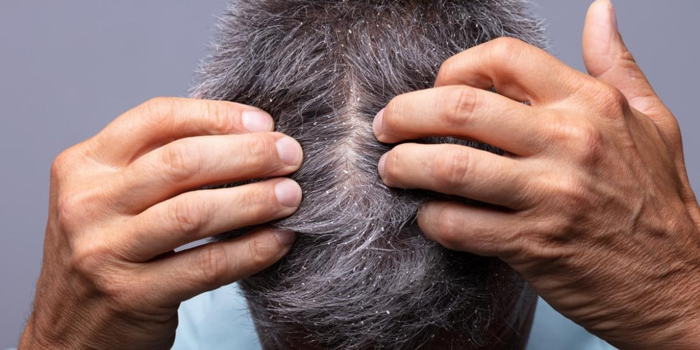 Dandruff in your hair, what to do?