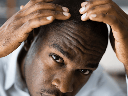 Efecto del ketoconazol y la piroctona olamina en el crecimiento del cabello