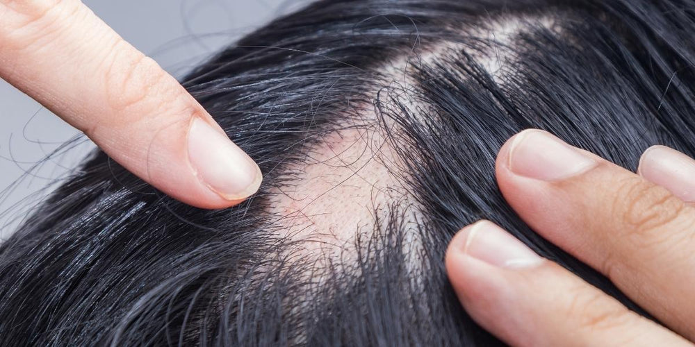 You spotted a bald spot on your head. What now?