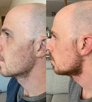 3x Neofollics beard growth serum + free beard roller